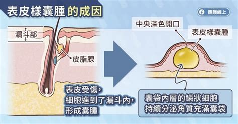 臉上有一顆凸起|臉上凸起「一粒」竟不是痘痘！醫揭「表皮樣囊腫」特。